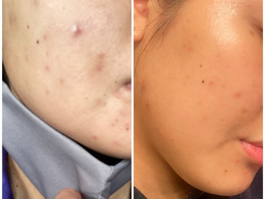 Help for Dry Skin & Breakouts