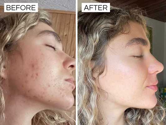 Tiffany’s Skin Transformation