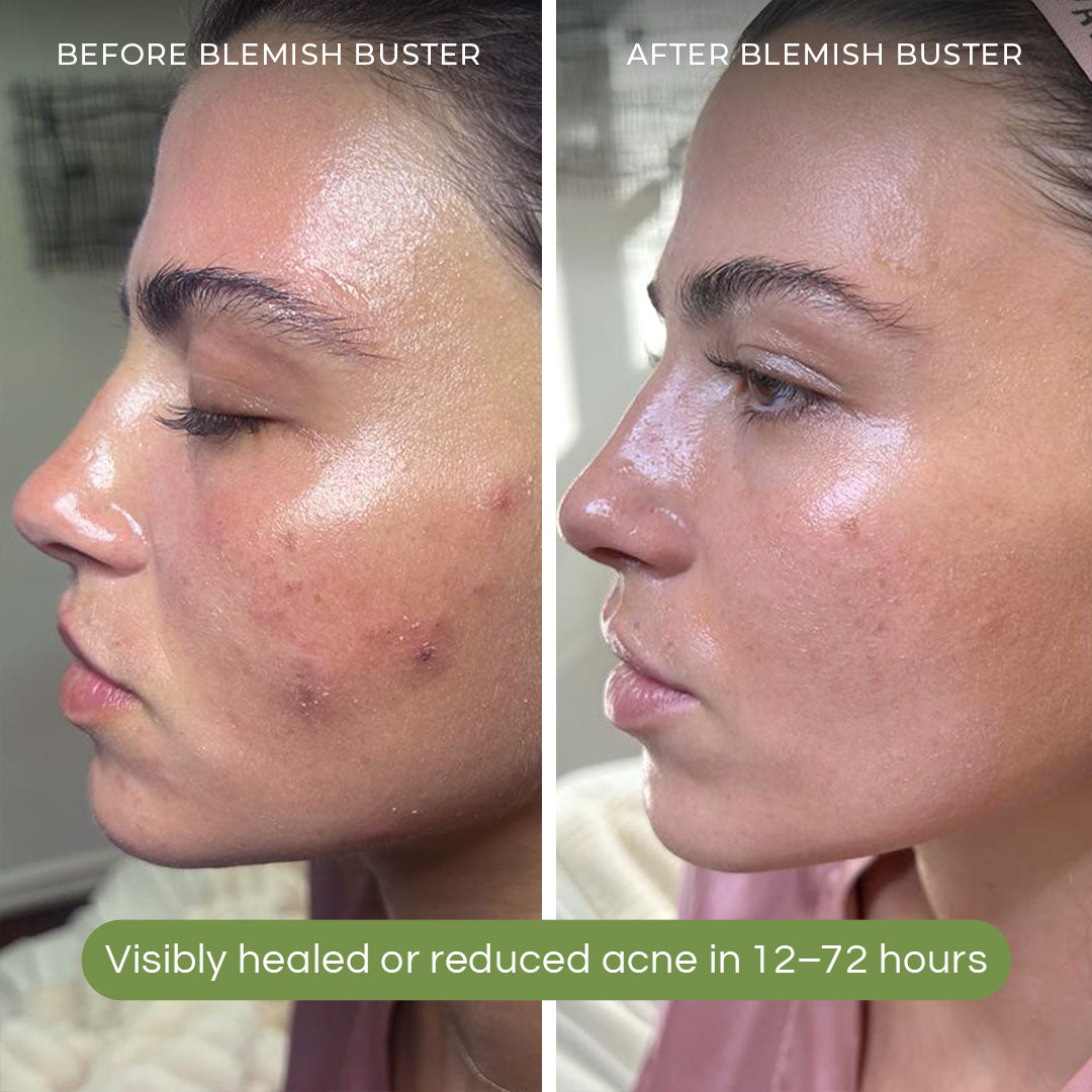 Blemish Buster