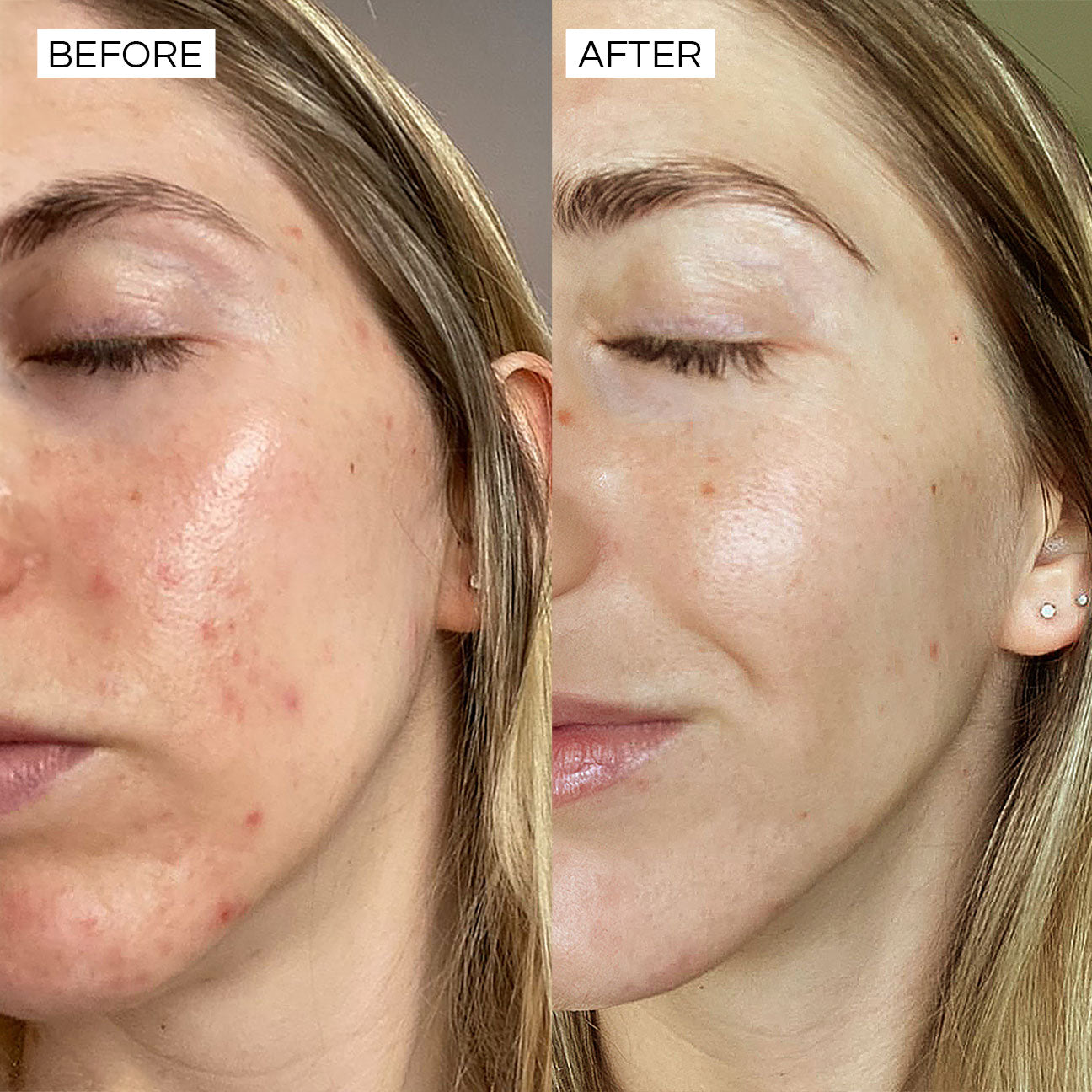 Clear skin fast with natural ingredients. Pimples are diminshed and skin is healthy.