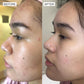 Clear acne fast. Dramatic improvments in clear skin with Sonya Dakar Blemish Buster