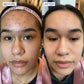 Clear skin solutions. Dramatic improvments in clear skin with Sonya Dakar Blemish Buster