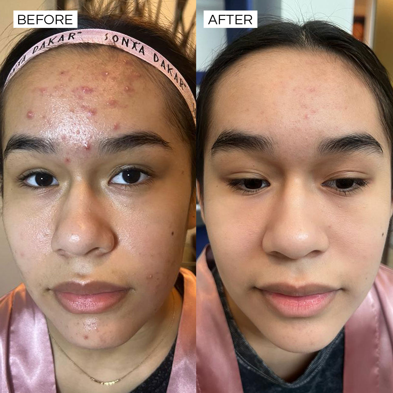 Clear skin solutions. Dramatic improvments in clear skin with Sonya Dakar Blemish Buster