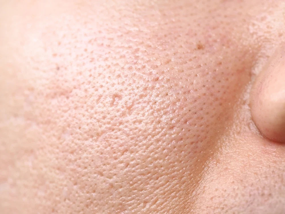 How to Shrink Pores