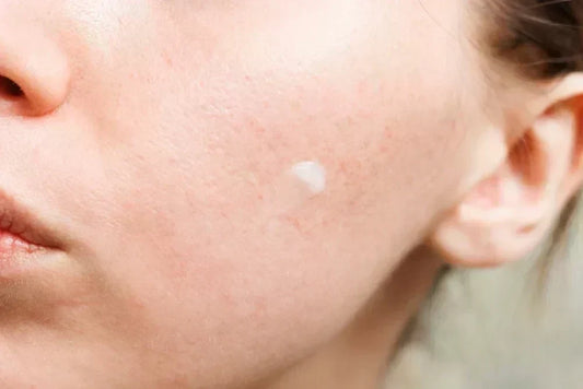 How to Use Retinol Without Irritating Your Skin