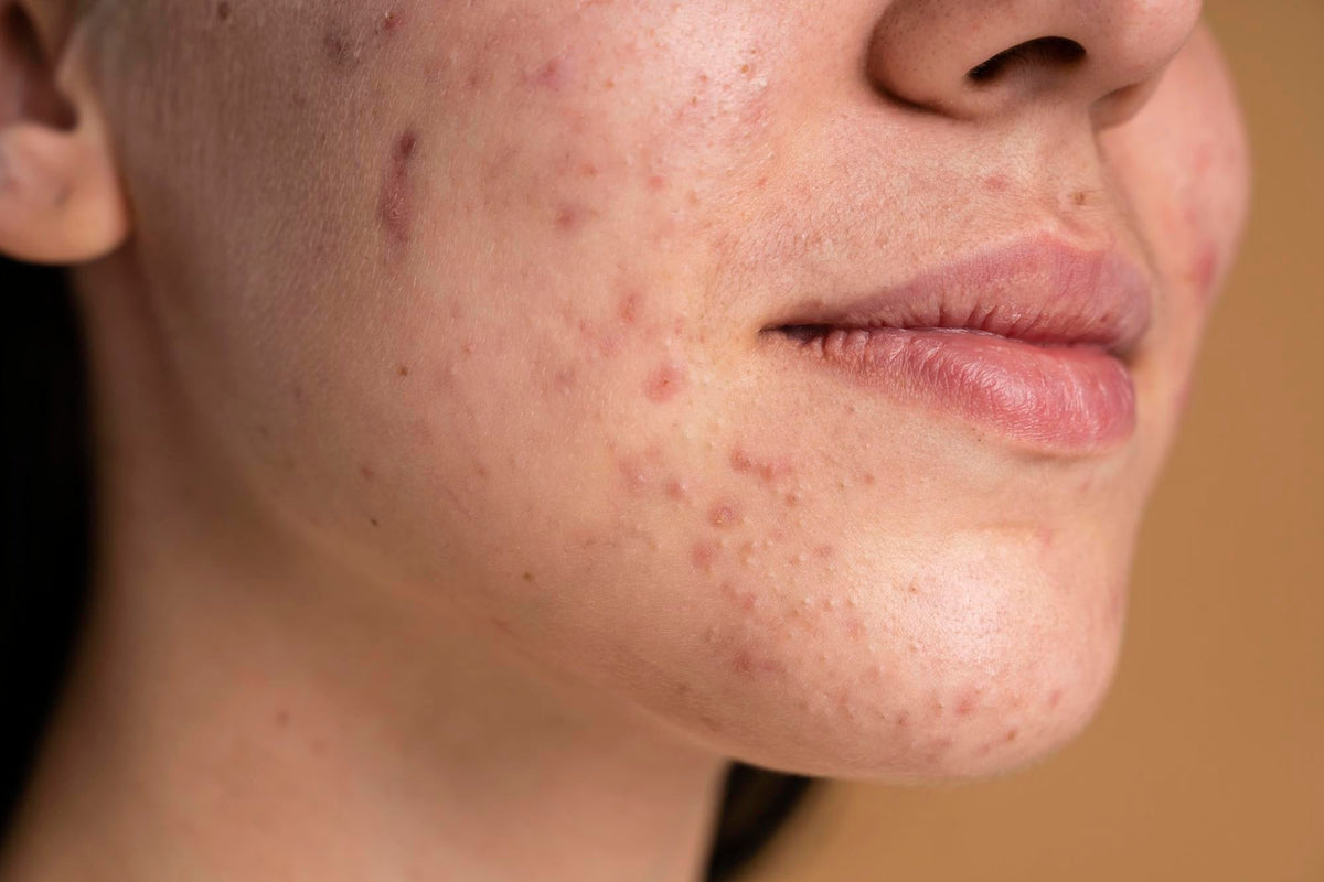 Hormonal Acne Causes and how to treat them