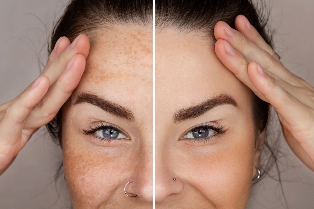 patient showing removal of dark spots on her face in the office