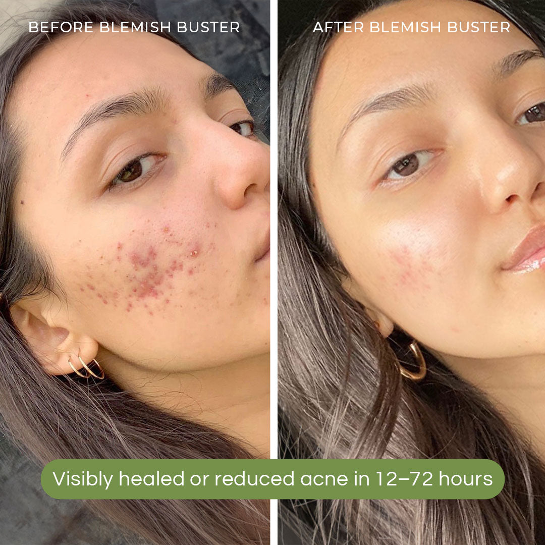 Sonya Dakar Blemish Buster - Tinted Acne Spot Treatment with probiotics and  salicylic acid – SONYA DAKAR