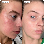 Before and after Barrier Bliss showing reduced redness and rosacea symptoms