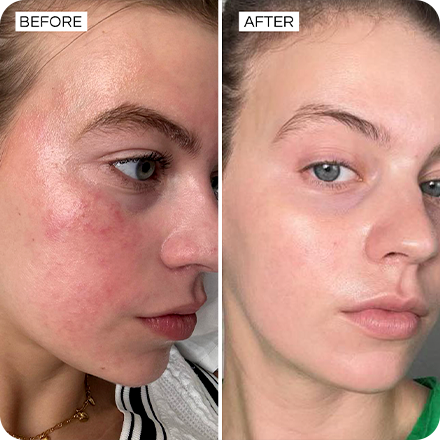 Before and after Barrier Bliss showing reduced redness and rosacea symptoms