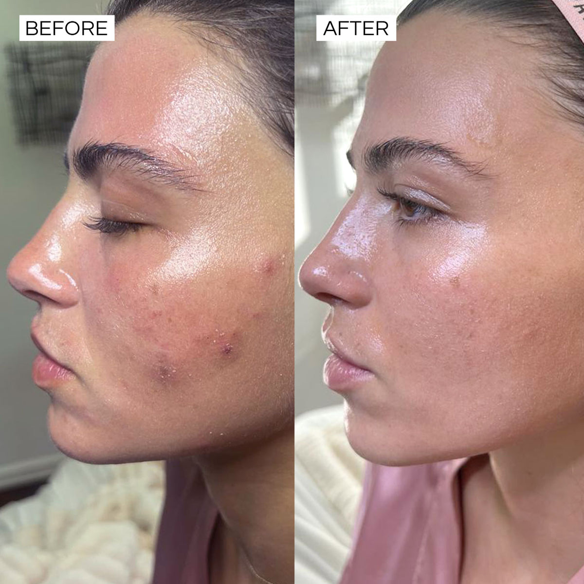 Super Clear before and after – even skin tone and reduced acne scarring