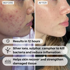 Zit Buster accelerates skin recovery and helps repair tissue after breakouts