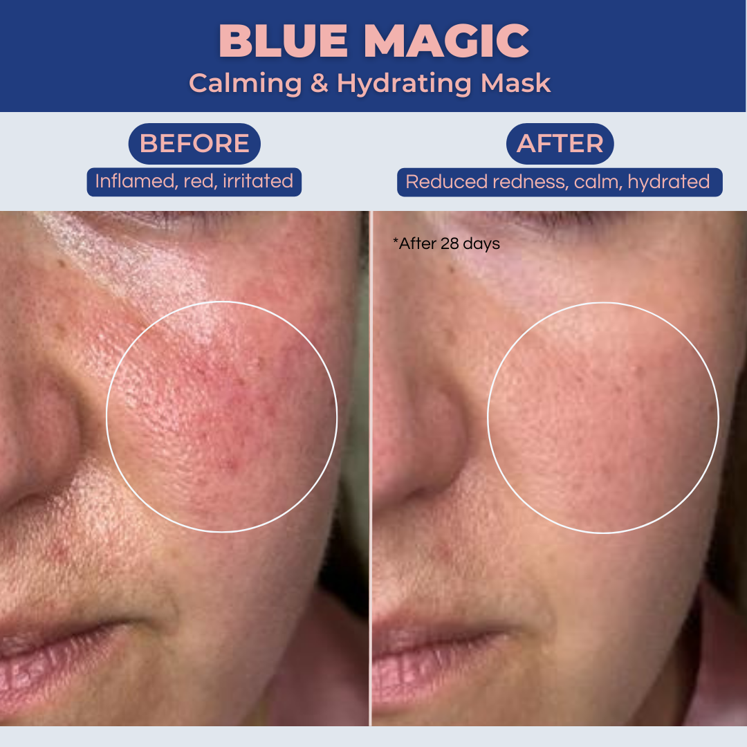 Blue Magic targets redness and inflammation