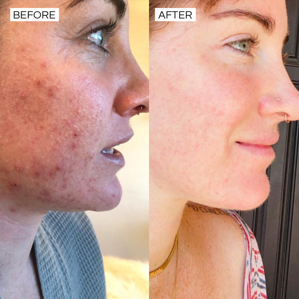 Super Clear before and after – clearer skin and reduced breakouts