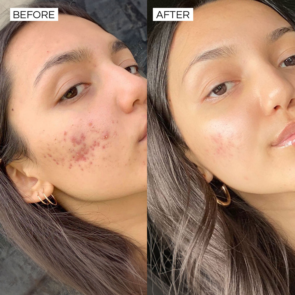Super Clear before and after – pores minimized and oil production balanced