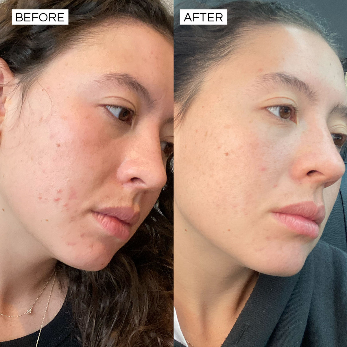 Super Clear before and after – visible improvement in skin clarity and texture