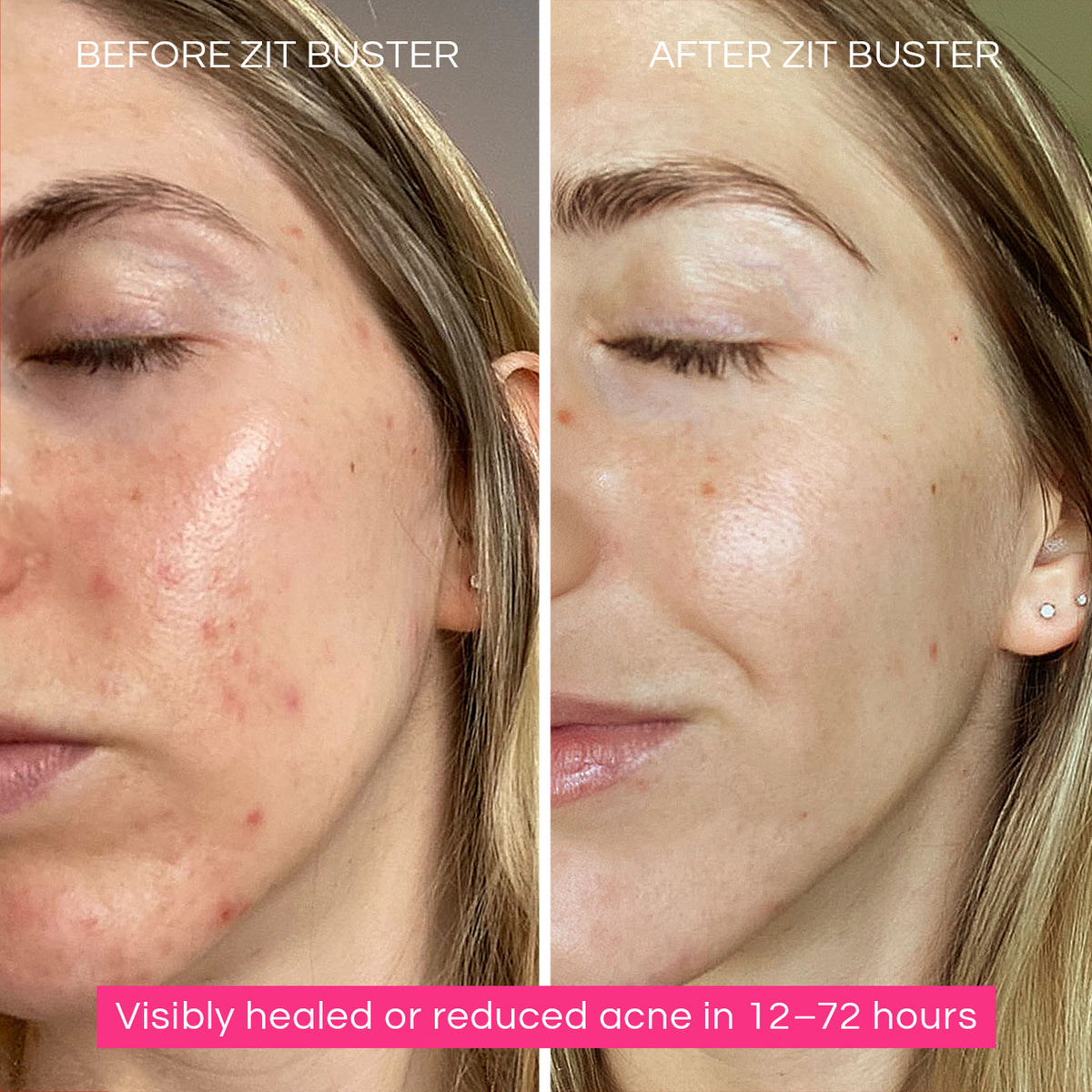 Before and after Zit Buster showing visible acne reduction in as little as 12 hours