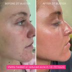 Before and after Zit Buster acne treatment – results visible in 12 to 72 hours