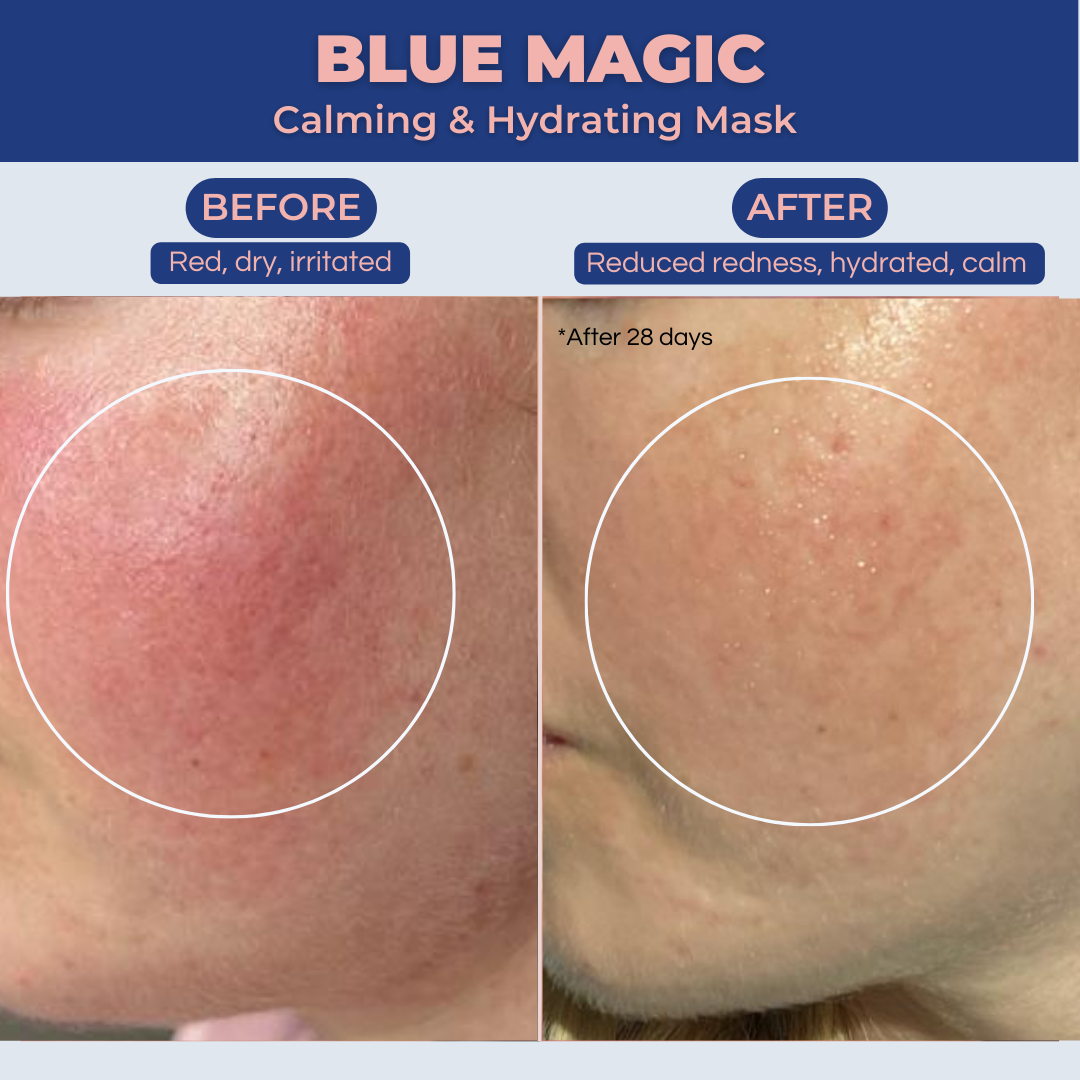 Blue Magic mask reduces redness, increases hydration, and calms inflammation