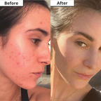 Clarifying Beauty Box products laid out – 7-piece acne-fighting regimen for oily skin