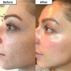 SuperLift eye serum with hyaluronic acid and copper complex – before and after eye area